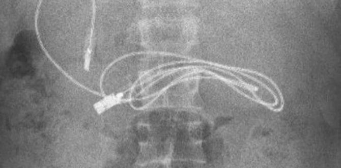 Esta es la radiografía de un adolescente que se tragó un cable.
