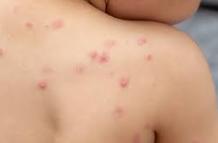 La viruela del mono se relacionaba con la encefalitis en brotes anteriores