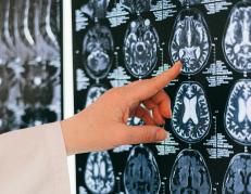 Imagen referencial. El paciente en cuestión tuvo un aneurisma cerebral.