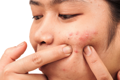 Logran reducir las cepas de las bacterias de la piel que causan el acné