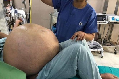 Imagen del tumor de 50 kilos antes de ser extirpado.