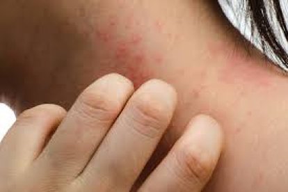 El vinagre puede calmar el dolor del Herpes zóster,