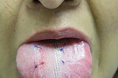 SI no hay sangrado durante la cirugía, el paciente es dado de alta.