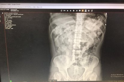 Los sospechosos fueron internados en un hospital de Quito hasta que expulsaran las cápsulas de droga.