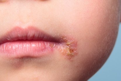 Se trata de una infección común en los niños.