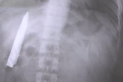 La radiografía muestra la hoja de cuchillo alojada en el torso de la víctima de un ataque.