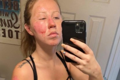 La joven terminó con quemaduras de segundo grado.