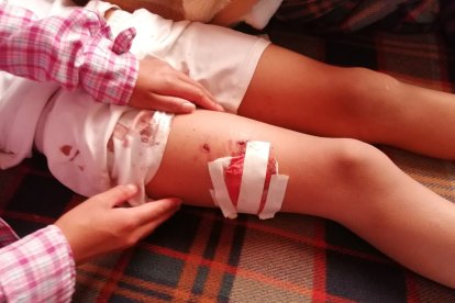 El pequeño Wilson se recupera en casa después de la agresión que sufrió por un perro,