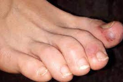 Algunos pacientes con Covid desarrollan un daño en los dedos de sus pies.