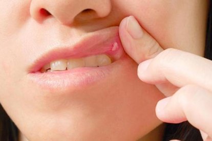 Las aftas pueden ser dolorosas. Evite cítricos y picantes.