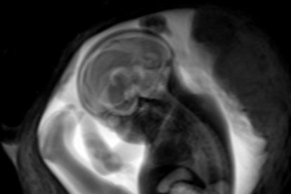 Imágenes de una resonancia magnética en el desarrollo del cerebro fetal.