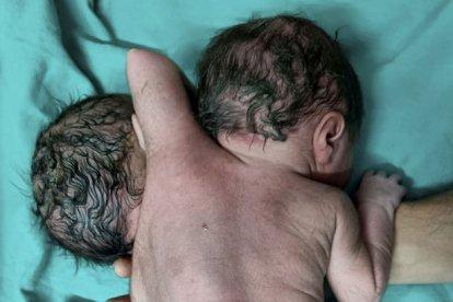 ¡Nació un bebé con dos cabezas, dos corazones y tres brazos!