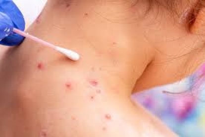 Secuelas de la viruela del simio.