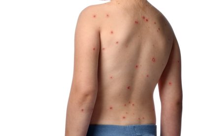 Las erupciones o rash en la piel son uno de los síntomas de la enfermedad.