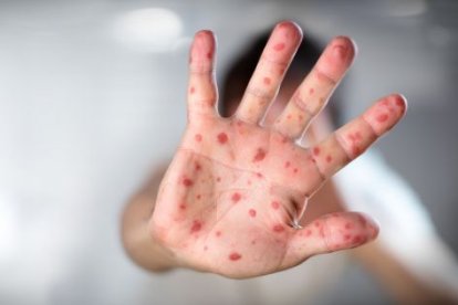 Argentina confirma un tercer caso de viruela de mono