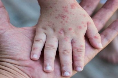 Detectan el primer caso de viruela del mono en Venezuela