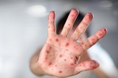 El paciente presenta fiebre y vesículas. La ministra Garzón informó que se realizó la toma de muestra para descartar la enfermedad.