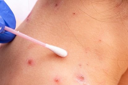 Bolivia reporta dos casos sospechosos de viruela del mono