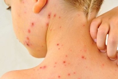 OMS decide que viruela del mono no es una emergencia sanitaria internacional