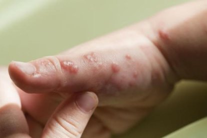 Casos de viruela del mono aumentan un 77 % en el mundo en una semana