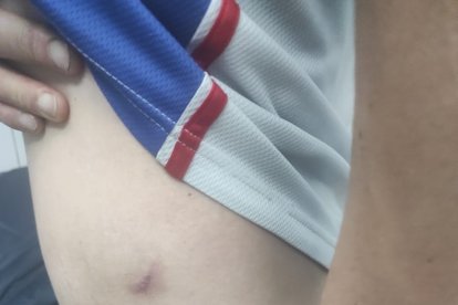 El arma que se usó era traumática. La víctima muestra la herida.