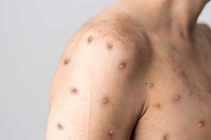 El MSP no precisa detalles sobre el tercer contagiado y anuncia que alista lineamientos de respuesta ante la declaratoria de emergencia internacional.