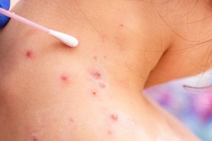 España confirma la segunda muerte por viruela del mono