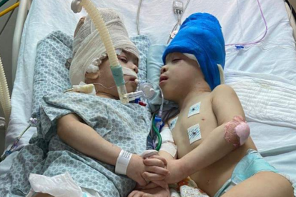 Bernardo y Arthur Lima fueron separados con éxito tras una operación de 27 horas.