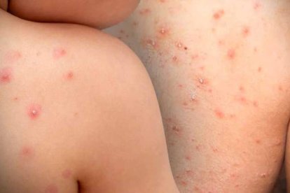 OMS dice que el brote de viruela del mono se debe a contagio entre personas