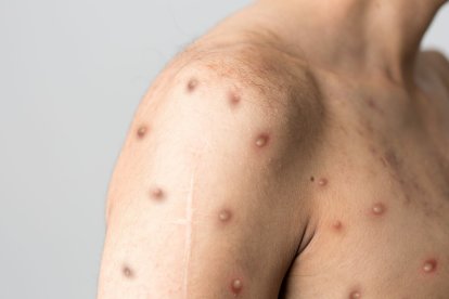 La OMS da nuevos nombres a las variantes de la viruela del mono