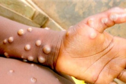 Los granos o protuberancias son características inherentes a este mal.