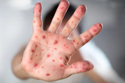 Los casos de viruela del mono continúan en aumento en Ecuador.