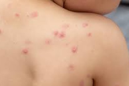 La viruela del mono se relacionaba con la encefalitis en brotes anteriores