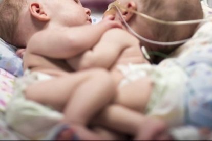 Nacen siameses unidos por el tórax y el abdomen en República Dominicana