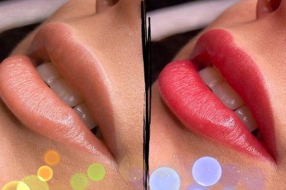 El procedimiento dura de 40 a 60 minutos.