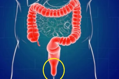 Cáncer de ano puede prevenirse detectando a tiempo algunos síntomas.