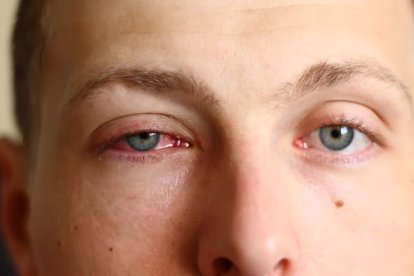 Referencial. Solo en algunas ocasiones, la conjuntivitis puede volverse infecciosa.