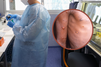 Para finales del 2022, la OMS alertó de un brote de este patógeno en los países de África.