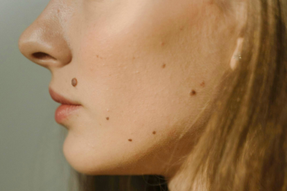 Aprende a evaluar tus lunares y detectar posibles signos de cáncer de piel