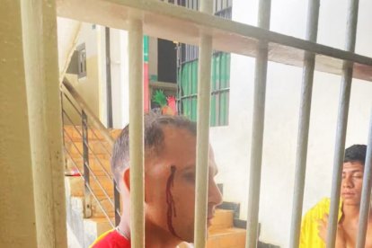 Presos en la cárcel Ramo Verde muestran las heridas causadas por los militares.