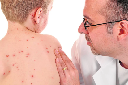 El sarampión pone en riesgo la salud y es una de las principales causas de muerte infantil a nivel mundial