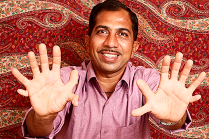 El hombre de 43 años tiene 28 dedos y dice que es una bendición.