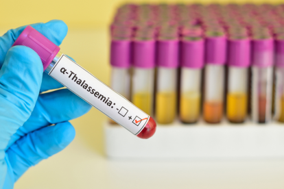 La detección temprana puede cambiar la vida de quienes heredan esta condición genética.