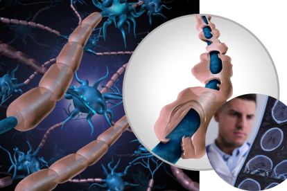 La esclerosis múltiple afecta a personas jóvenes, mayormente mujeres, entre los 20 y 40 años.