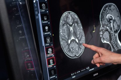 El descubrimiento detecta un camino en tres hitos hacia la pérdida de memoria