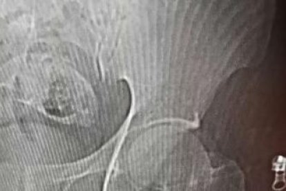 Los rayos X muestran dónde estaba metido el pez.