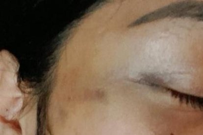 Así quedó el rostro de la joven tras la agresión.