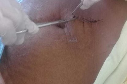 A través de esta incisión se logró extraer el instrumento quirúrgico.
