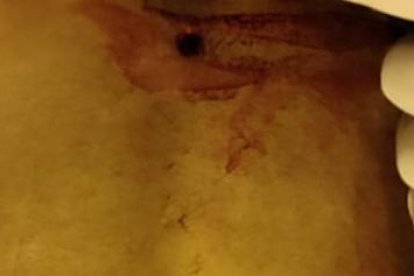 El proyectil habría perforado uno de sus pulmones.