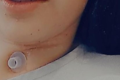 Una traqueotomía le realizaron para que pueda respirar mejor.